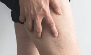 Read more about the article What Are Vascular Lesions